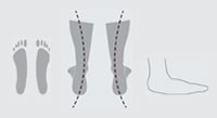 Flat Foot